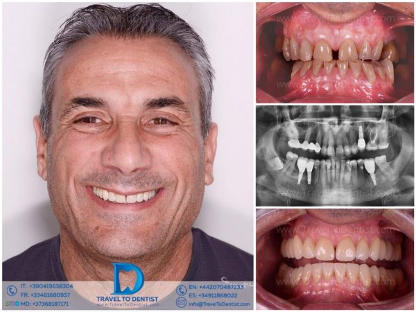 Caso clínico 2 - Resultado del tratamiento dental