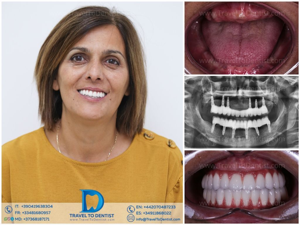 Caso clínico 5 - Resultado del tratamiento dental